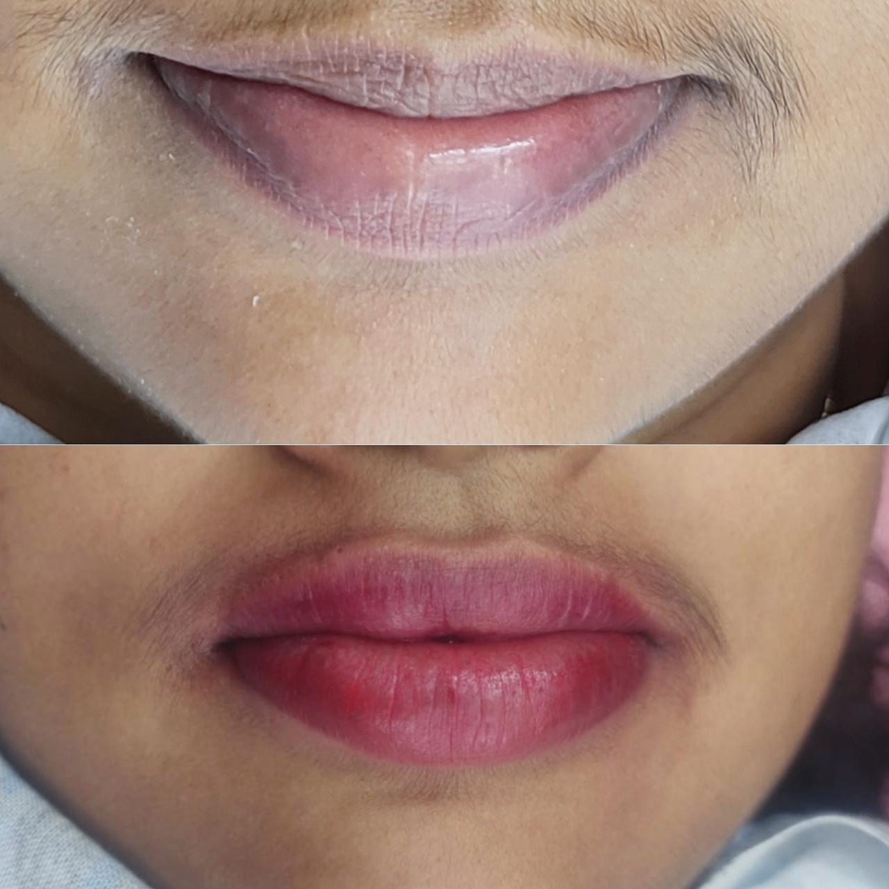 Hydra Facial